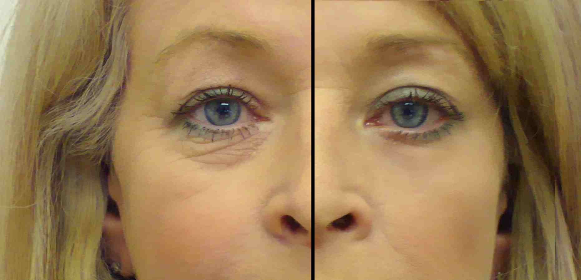 Puffiness Under Eye Images
